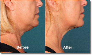 Kybella-Before-and-After-2
