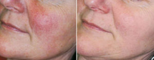 rosacea-before-after-600