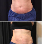 1 Treatment - 4 cycles to the abdomen